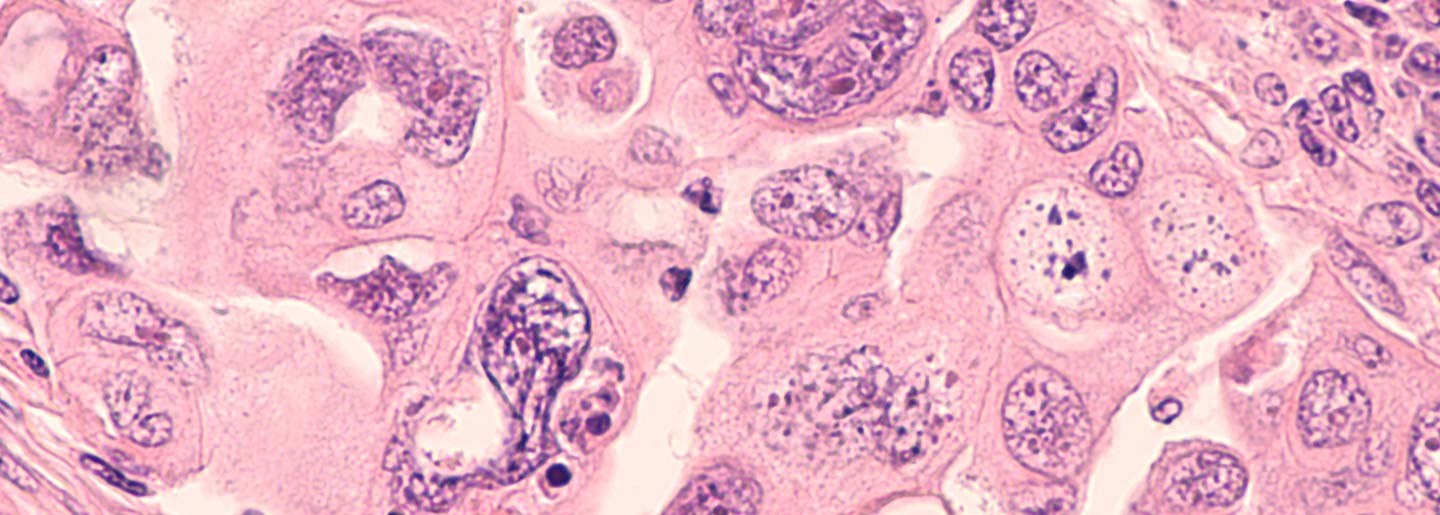 ovarian cancer cells under a microscope
