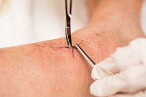 Skin excision for melanoma