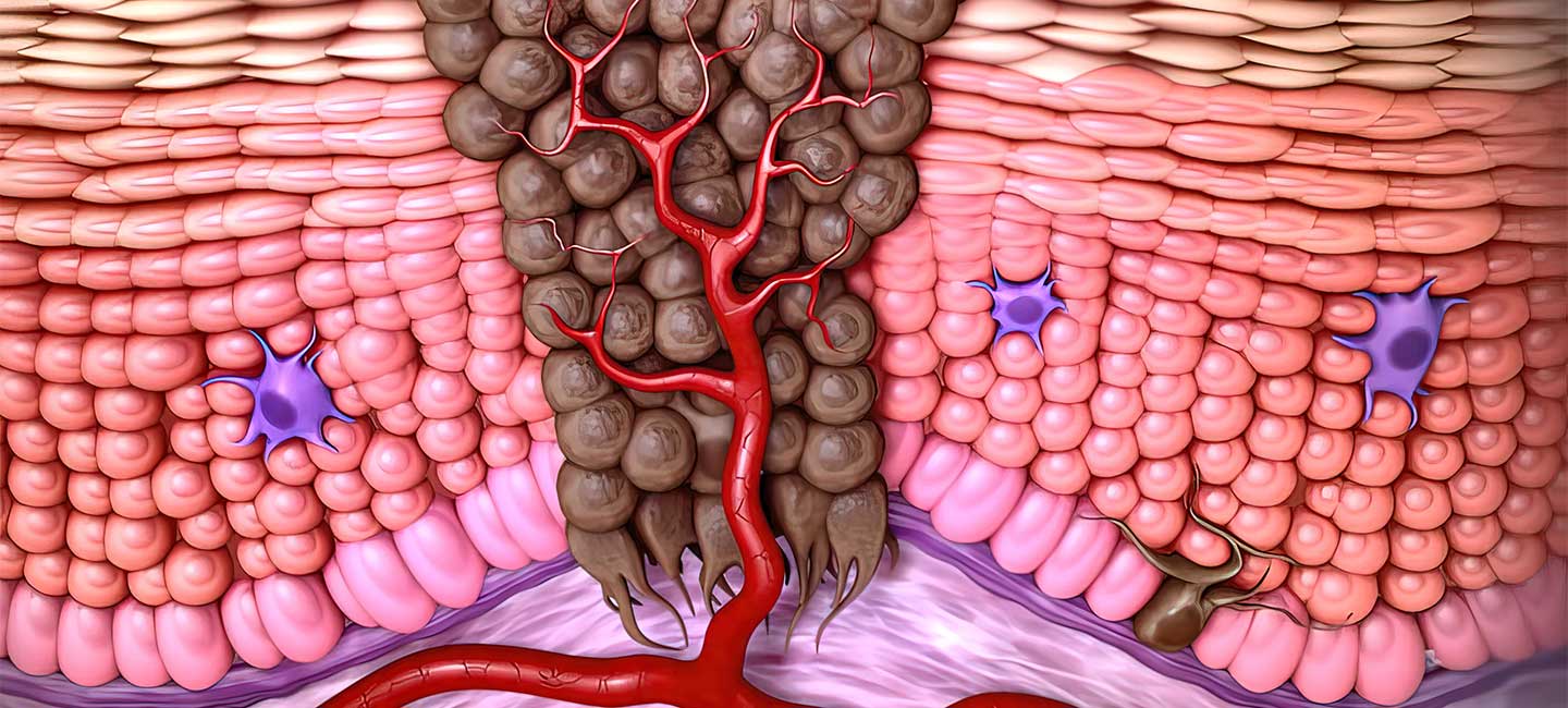 medical illustration of skin cancer: Squamous cell carcinoma, basal cell cancer