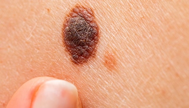 Understand melanoma symptoms and atypical moles