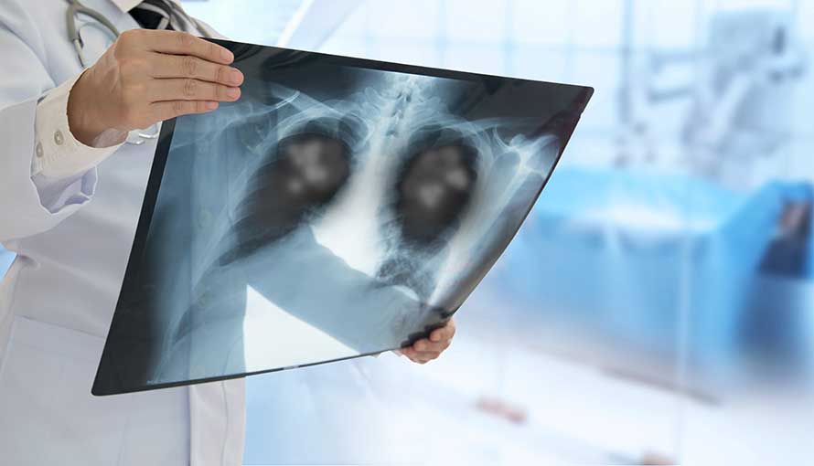 a doctor looks for lung cancer in chest scans