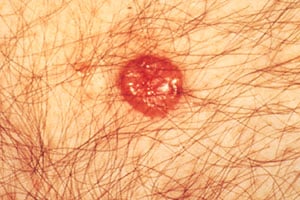 Red bump, basal cell carcinoma