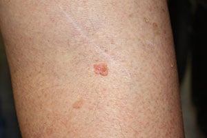 skin cancer blisters