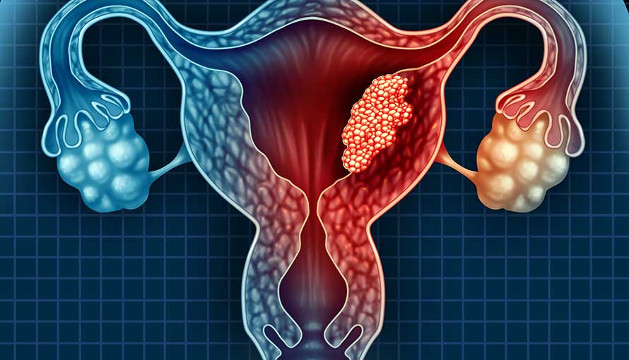 illustration of endometrial cancer