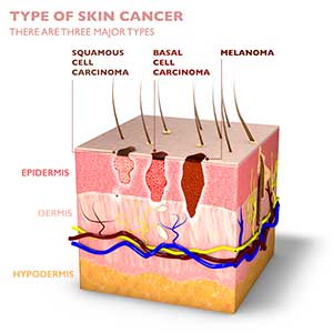 Types of skin cancer graphic