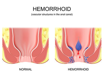 location where a hemorrhoid forms