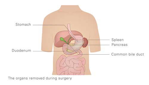 The diagram above depicts the organs removed during a total pancreatectomy procedure.
