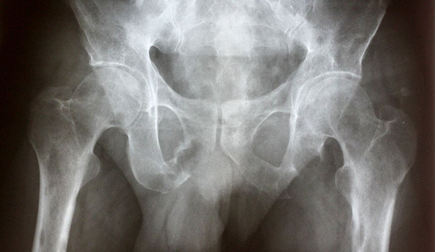 x-ray of pelvis bone