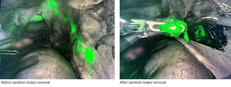 Sentinel nodes removal before and after