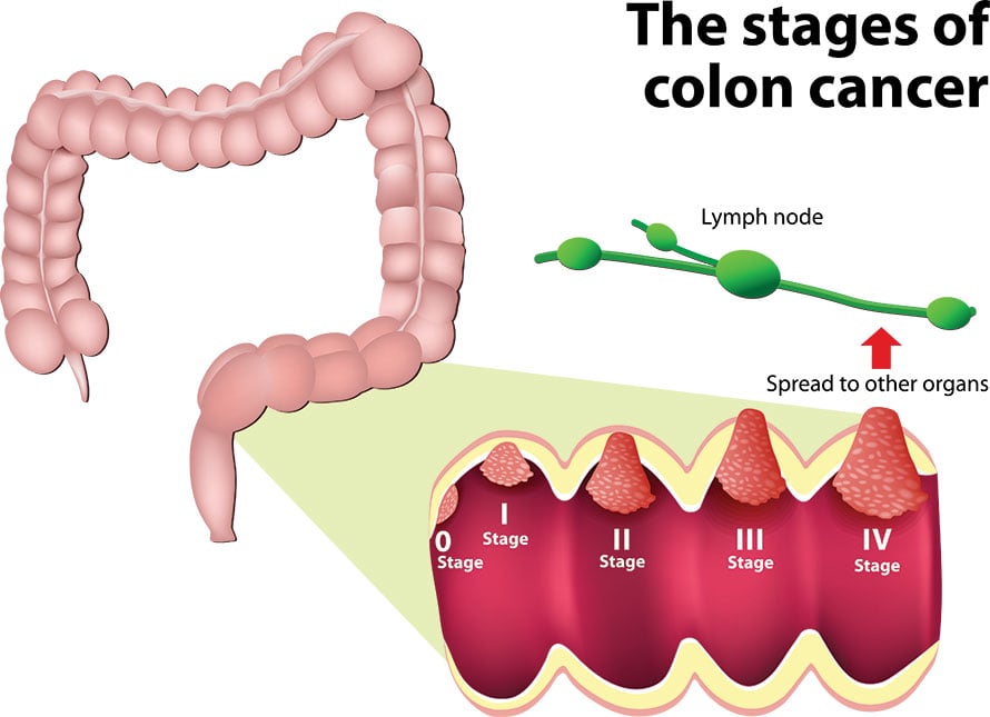 stages of colon cancer