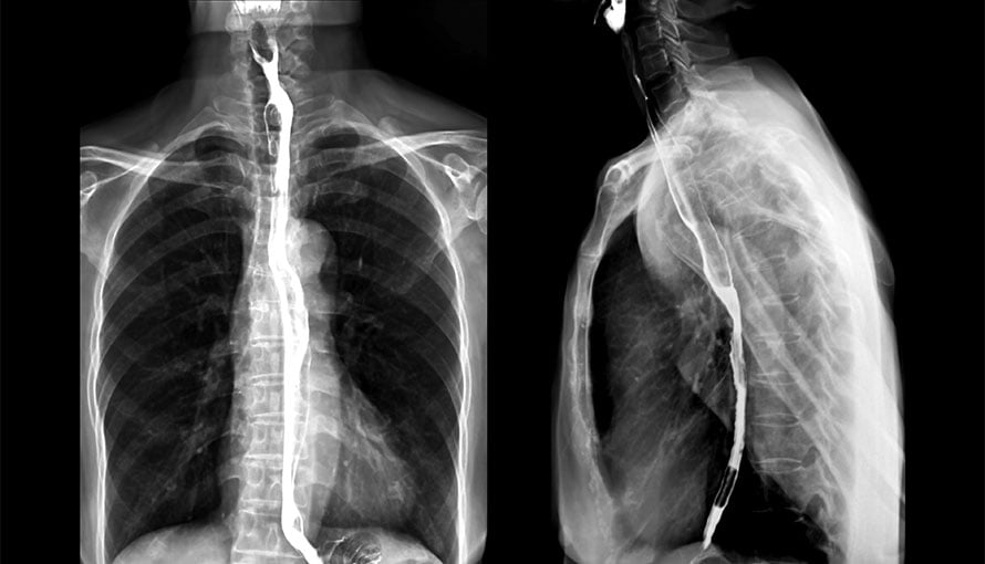 x-ray of esophagus