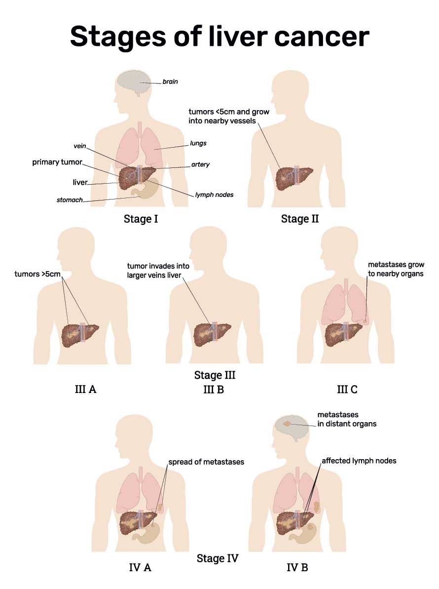 Stages of liver cancer illustration