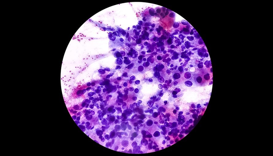 Spindle cell sarcoma cells seen under a microscope