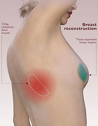 Breast reconstruction graphic
