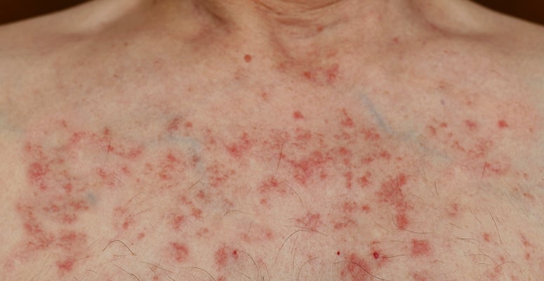 Allergic skin reaction on a man's chest after chemotherapy. 