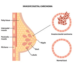 invasive ductal carcinoma stages graphic