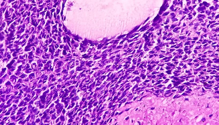 Synovial sarcoma cells seen under a microscope