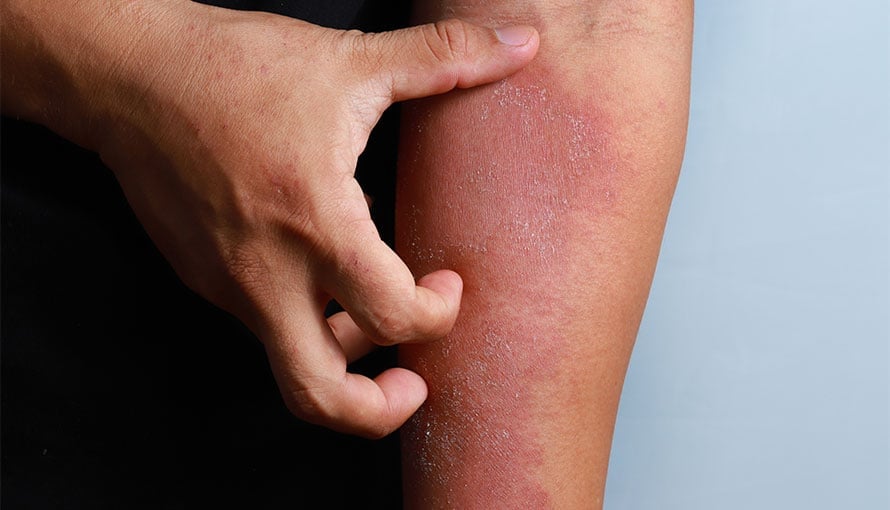a person is scratching a rash on their arm