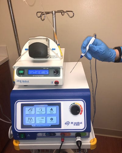 The RFA needle generates radiofrequency waves which heat up and destroys the tissue around the needle tip.