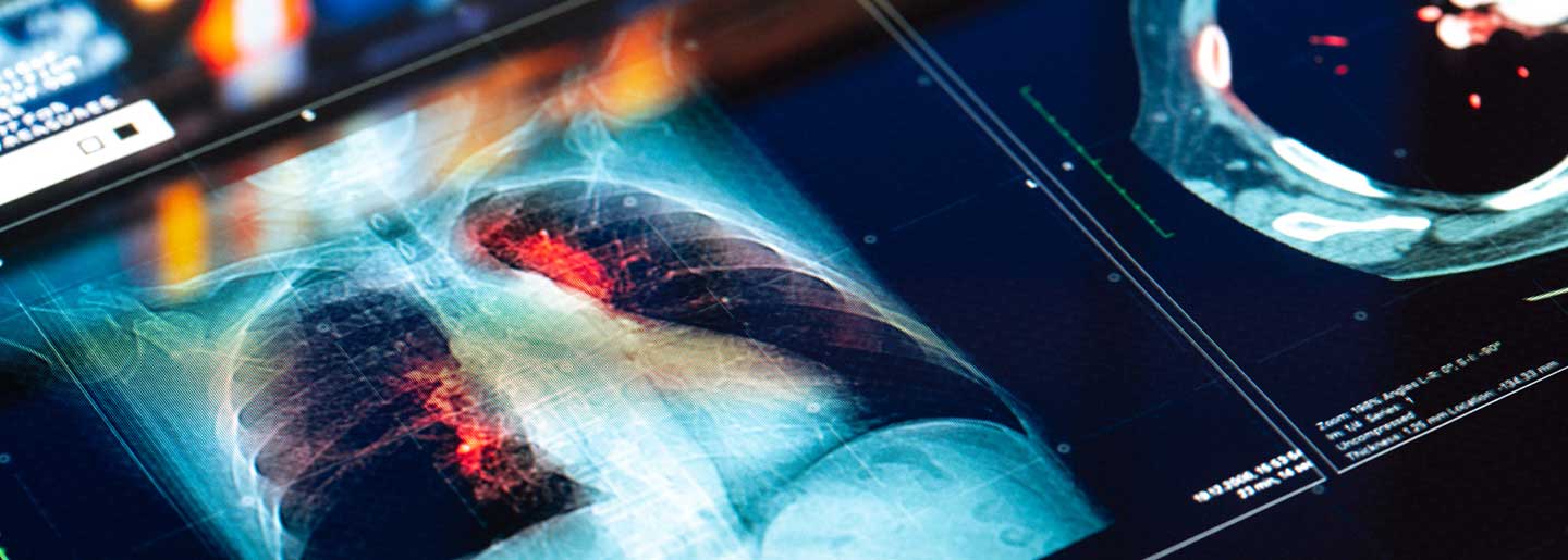 Medical MRI lung Scan on digital screen