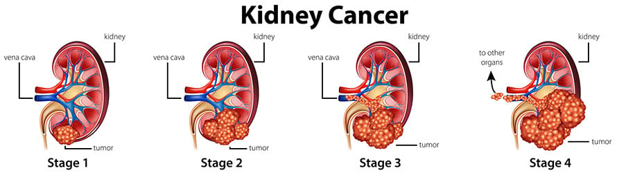 Kidney (Renal Cell) Cancer Stages | Moffitt