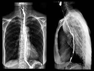 X-rays following a barium swallow