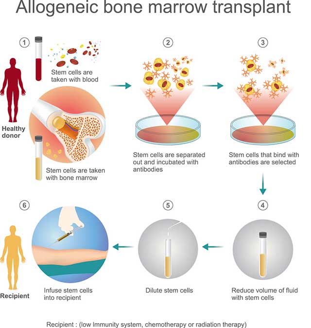 Steps in an allogeneic bone marrow transplant