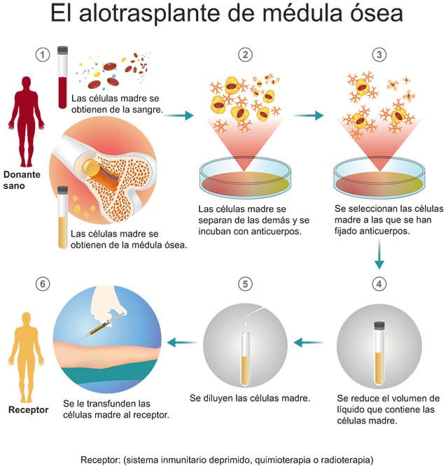 alotrasplante de células madre