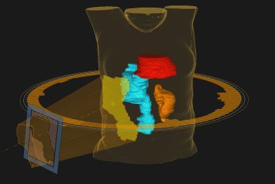 The radiation therapy team used 3D models to plan the treatment. A multi-leaf collimator shapes the radiation beam to hit the tumor (blue) and decrease exposure to surrounding heart (red) and kidney (orange).