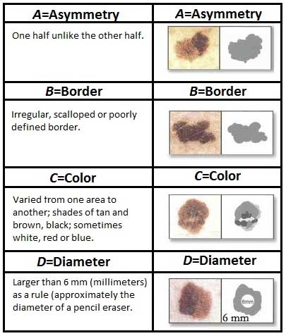Graphic showing ABCD of melanoma signs
