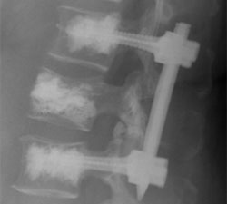 percutaneous pedicle screw fixation
