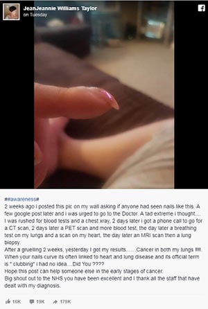 Woman's fingernails lung cancer sign
