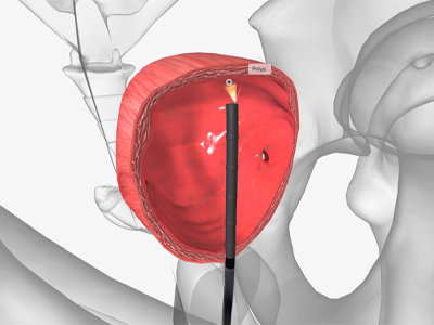 During a cystoscopy, doctors look for abnormal signs or symptoms of disease in the bladder. This has long been the standard of care for detecting bladder cancer.