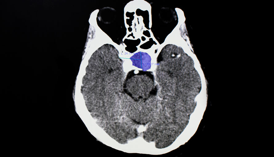 Brain scan of pituitary adenoma