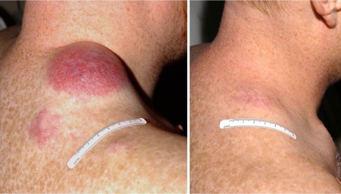 Before and after pictures of a patient with advanced melanoma