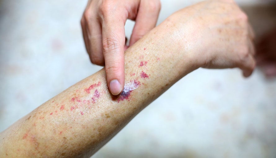 Petechiae or leukemia spots shown on woman's arm