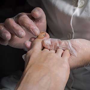 Doctor inspecting toe for subungual melanoma