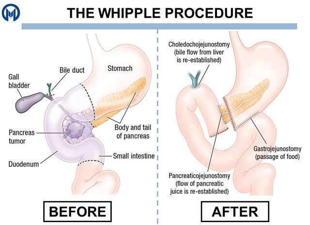 Whipple Procedure before and after