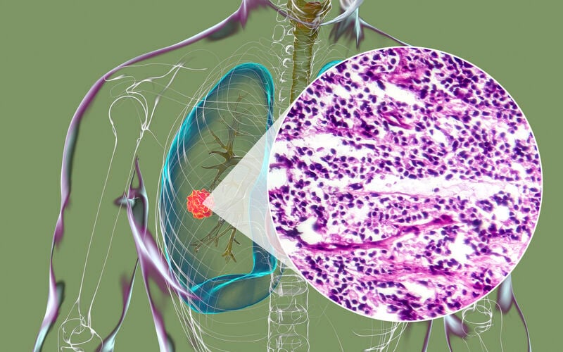 small cell lung cancer graphic