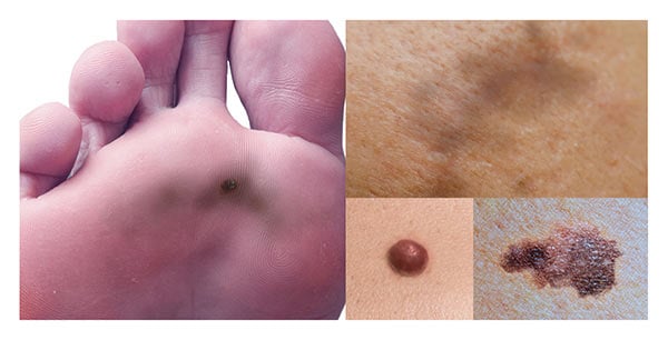 signs of melanoma