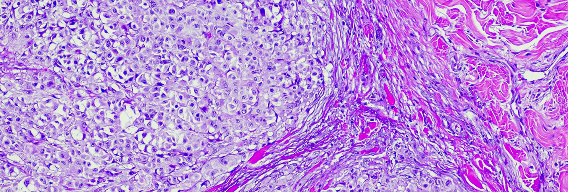 metastatic melanoma cells seen through a microscope slide